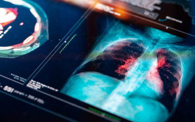 Novi lijek prepolovio rizik od smrti kod čak četiri oblika raka pluća