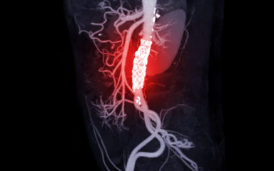 Medicinari priznali aortu kao zasebni ljudski organ, evo što će to značiti za pacijente