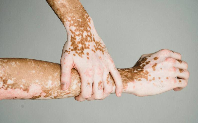 Vitiligo je bolest koja ostavlja trag  na koži i - psihi