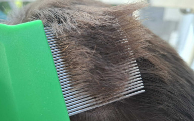 U zadarskim se vrtićima pojavile uši. Treba reagirati brzo