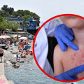 Zarazna infekcija prenosi se i preko ručnika, pedijatri objasnili kako ju prepoznati