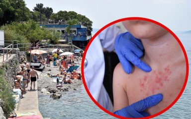 Zarazna infekcija prenosi se i preko ručnika, pedijatri objasnili kako ju prepoznati